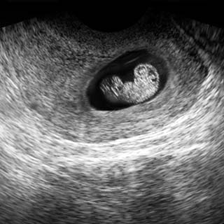 تصویر دو بعدی هفته هفتم بارداری - عکس جنین در هفته هفتم بارداری