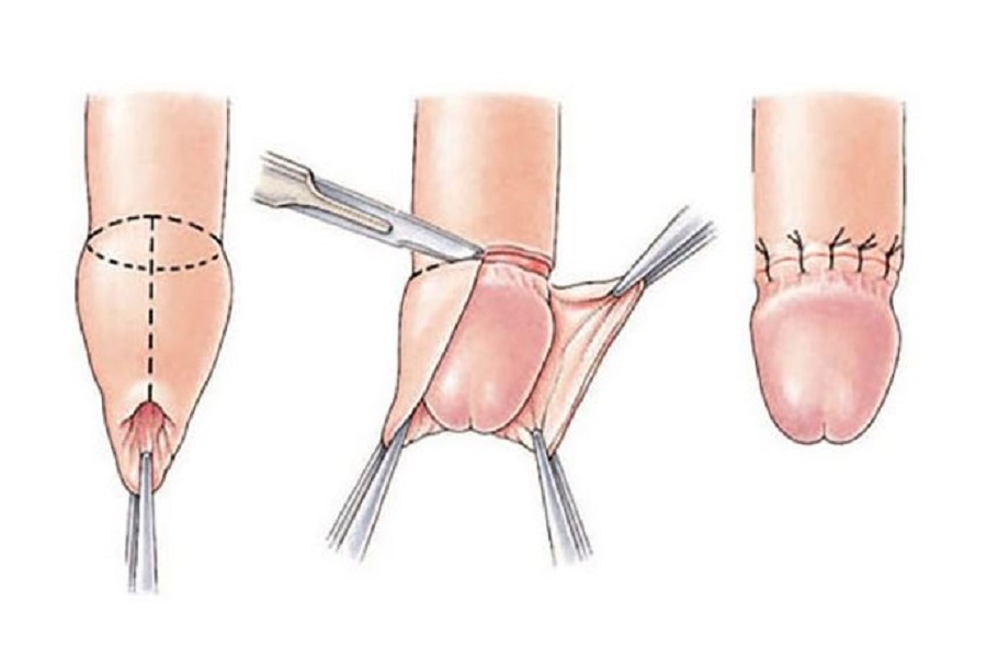 جراحی ختنه کردن