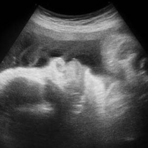 تصویر دو بعدی هفته سی و نهم بارداری - عکس جنین در هفته سی و نهم بارداری