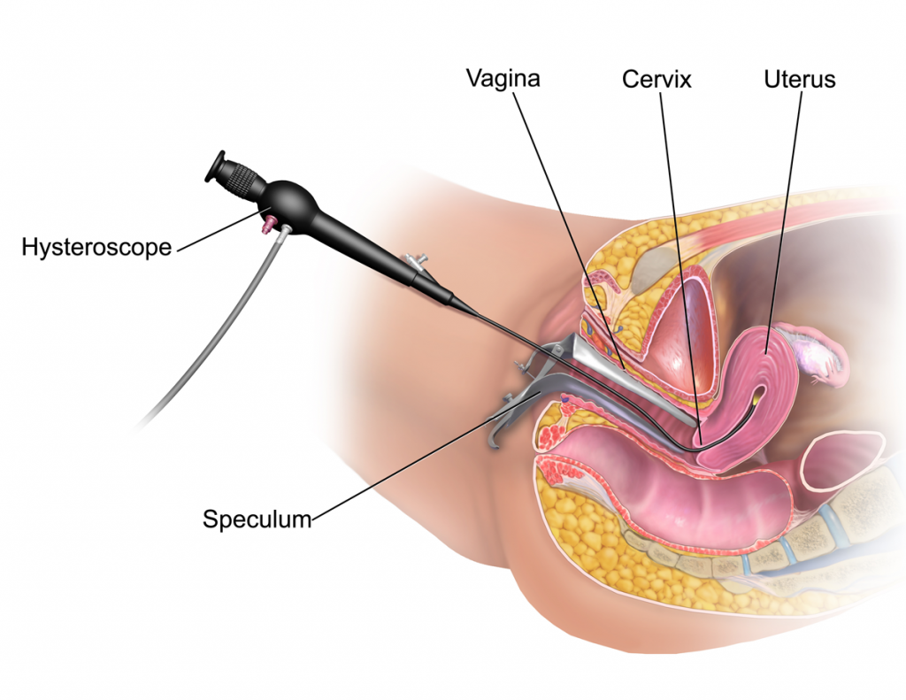 هیستروسکوپی رحمی برای بررسی خونریزی های غیر طبیعی رحمی