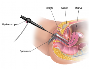 هیستروسکوپی رحمی برای بررسی خونریزی های غیر طبیعی رحمی