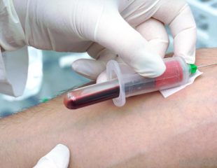 آزمایش میزان آلدوسترون در خون