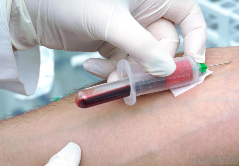 آزمایش میزان آلدوسترون در خون