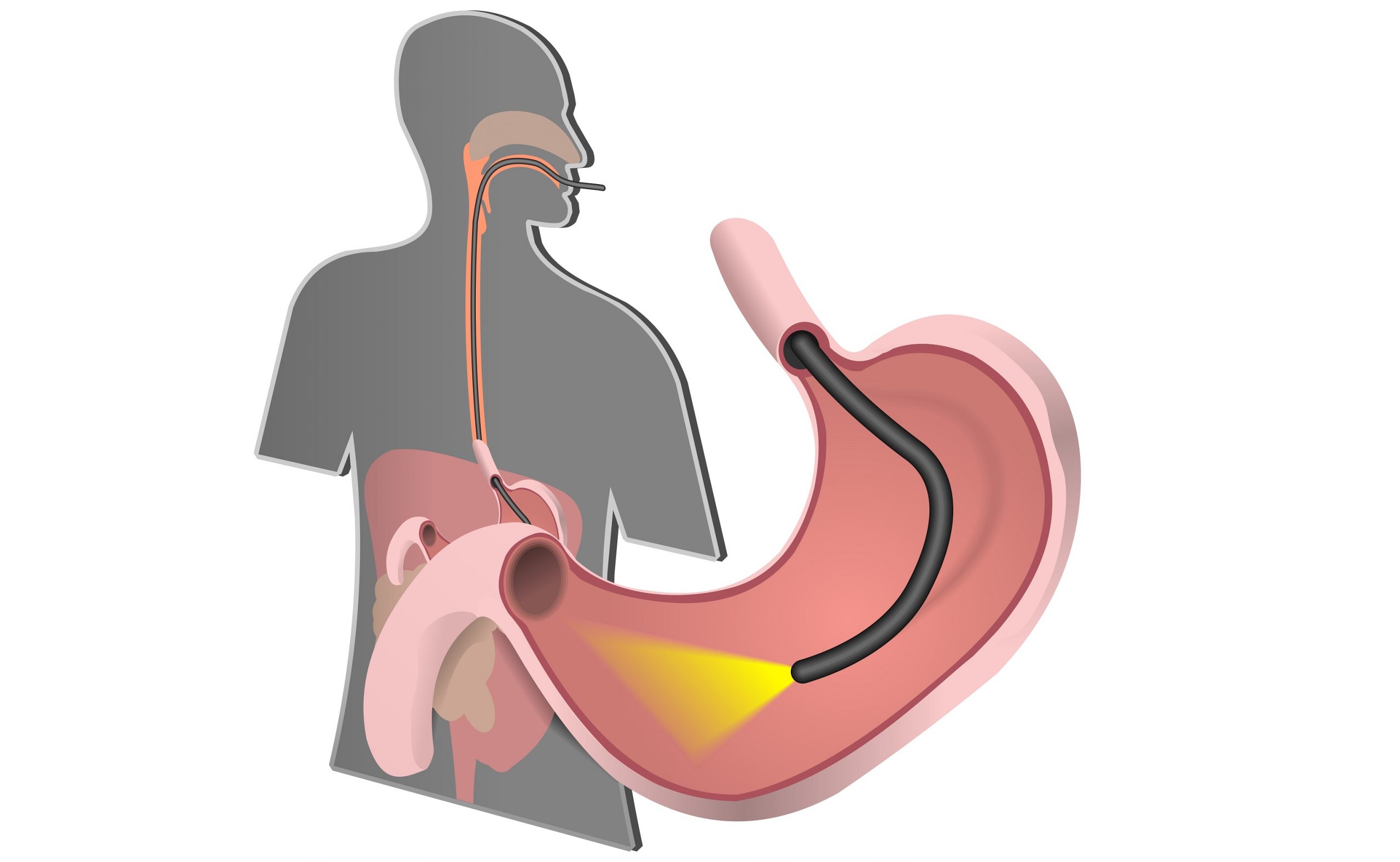 фгдс язвенная болезнь желудка и 12пк. хронический гастрит фгдс. двенадцатиперстная кишка фгдс. гастроскопия желудка гастрит. гастроскопия желудка гастрит.