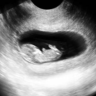 تصویر دو بعدی هفته دهم بارداری - عکس جنین در هفته دهم بارداری