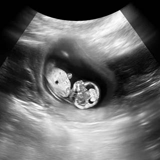تصویر دو بعدی هفته یازدهم بارداری عکس جنین در هفته یازدهم بارداری