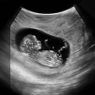 تصویر دو بعدی هفته دوازدهم بارداری - عکس جنین در هفته دوازدهم بارداری