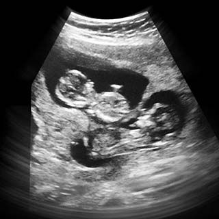 تصویر دو بعدی هفته سیزدهم بارداری - عکس هفته سیزدهم بارداری