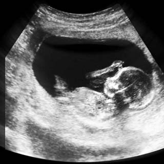 تصویر دو بعدی هفته چهاردهم بارداری - عکس جنین در هفته چهاردهم بارداری