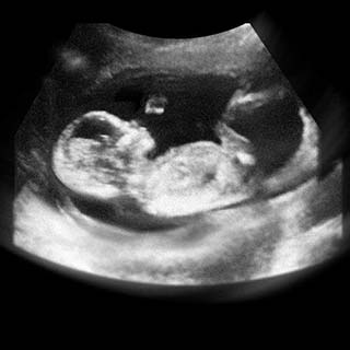 تصویر دو بعدی هفته پانزدهم بارداری