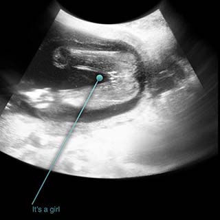 تصویر دو بعدی هفدهم هشتم بارداری -عکس جنین در هفته هفدهم بارداری