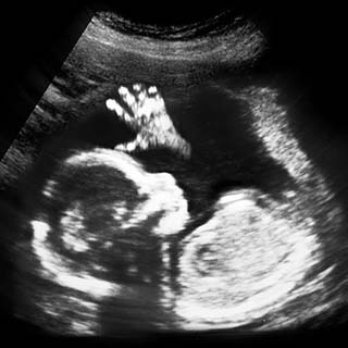 تصویر دو بعدی هفته هجدهم بارداری - عکس جنین در هفته هجدهم بارداری