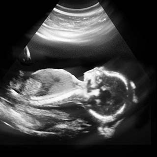 تصویر دو بعدی هفته بیستم بارداری - عکس جنین در هفته بیستم بارداری