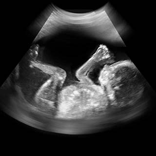 تصویر دو بعدی هفته بیست و یکم بارداری - عکس جنین در هفته بیست و یکم بارداری