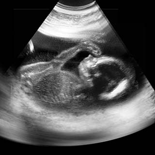 تصویر دو بعدی هفته بیست و پنجم بارداری - عکس جنین در هفته بیست و پنجم بارداری