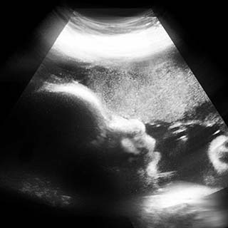 تصویر دو بعدی هفته سی و دوم بارداری - عکس جنین در هفته سی و دوم بارداری