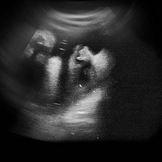 تصویر دو بعدی هفته سی و پنجم بارداری - عکس جنین در هفته بیست و پنجم بارداری