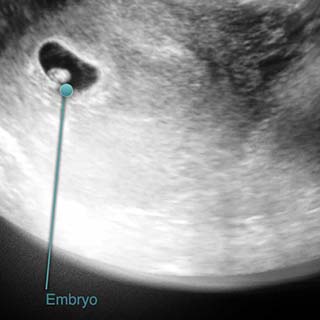 تصویر دو بعدی هفته ششم بارداری - عکس جنین 6 ماهه