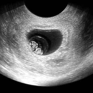 تصویر دو بعدی هفته هشتم بارداری - عکس جنین در هفته هشتم بارداری
