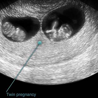 تصویر دو بعدی هفته نهم بارداری - عکس جنین در هفته نهم بارداری