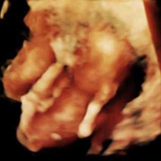 تصویر سه بعدی هفته هفدهم بارداری - عکس سونوگرافی جنین در هفته هفدهم بارداری