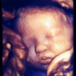 تصویر دو بعدی سی و هفتم بارداری