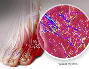 نقرس چیست ؟ علل، علائم و درمان