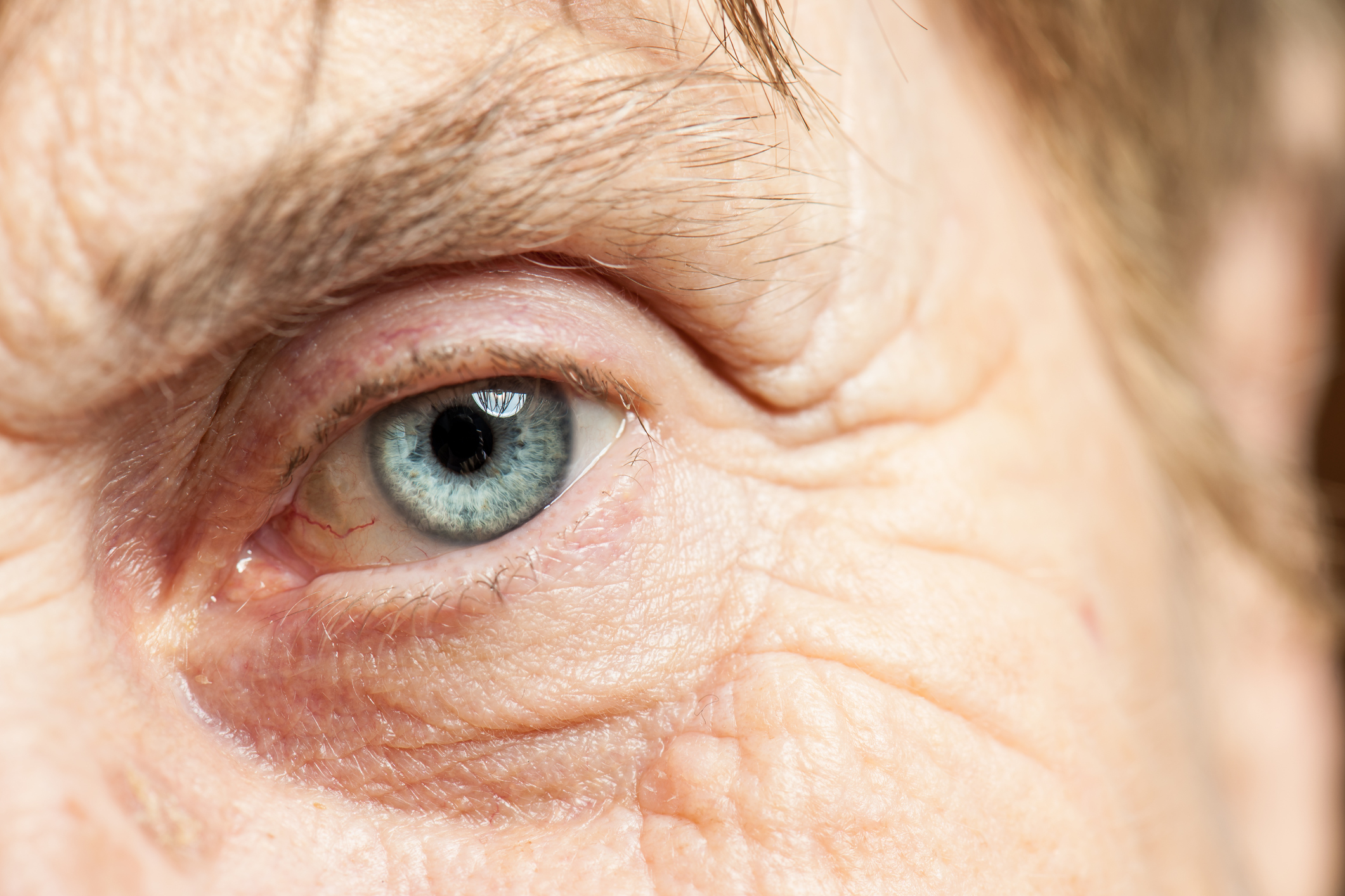 Начальная старческая катаракта. Сенильная диабетическая катаракта. Старческая(сенильная)катаракта. Заболевание глаз катаракта.