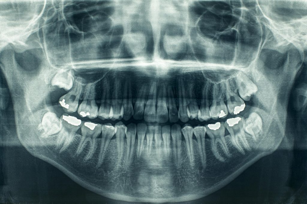 اشعه ایکس از دندان
