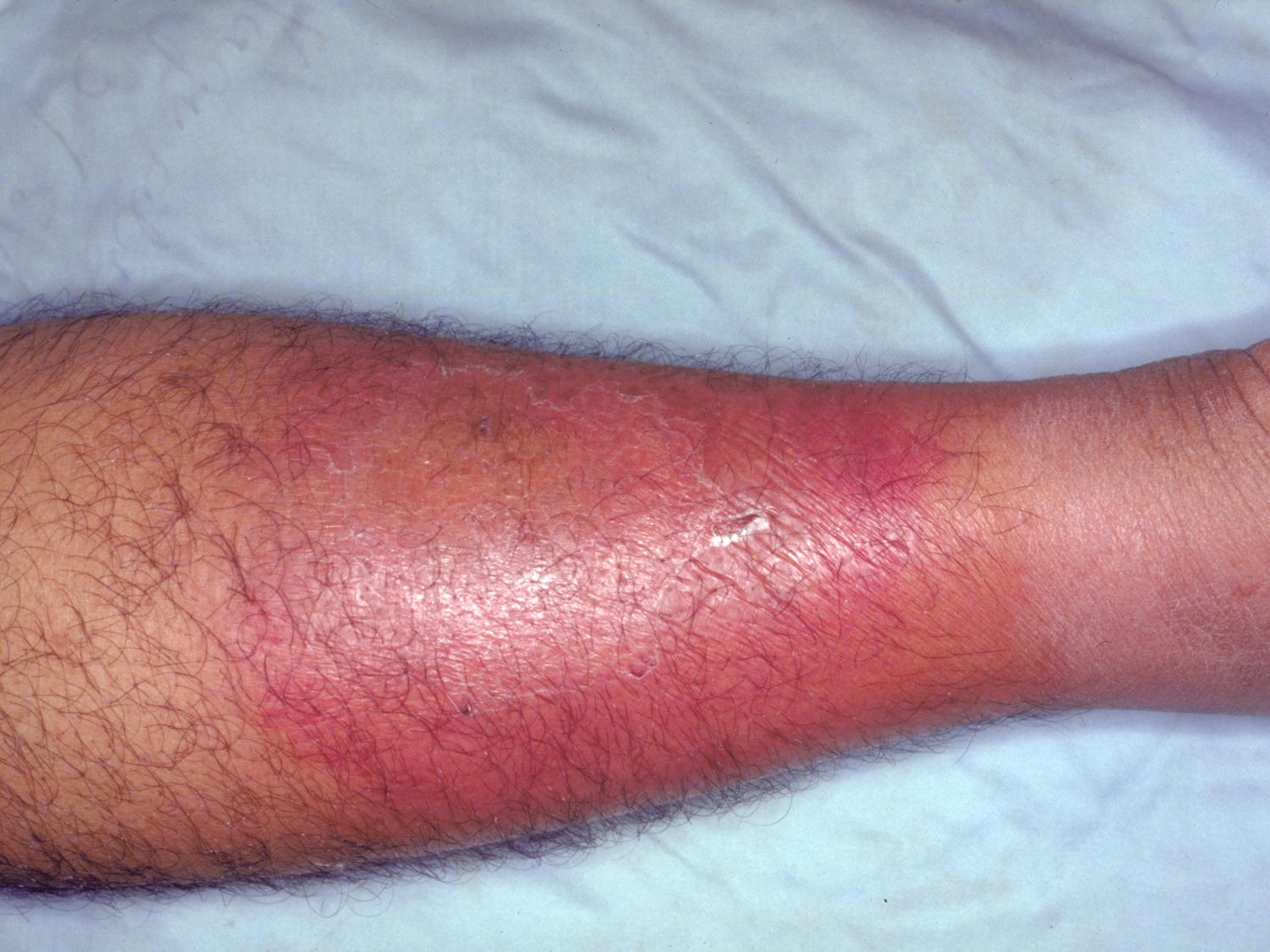 Sepsis Cellulitis Infection
