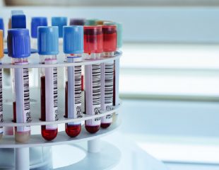آشنایی با نتایج آزمایشات خون مربوط به سرطان