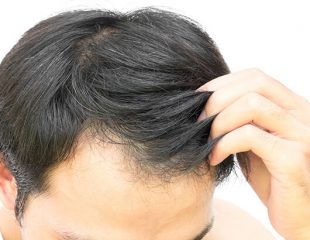 روگین برای درمان ریزش مو