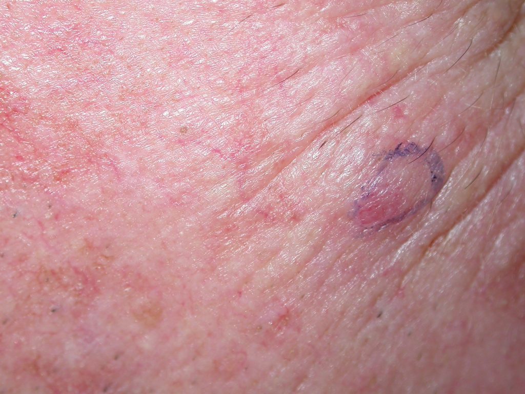 سرطان سلولی فلسی پوست