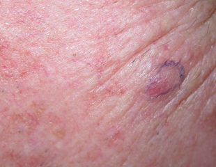 سرطان سلولی فلسی پوست