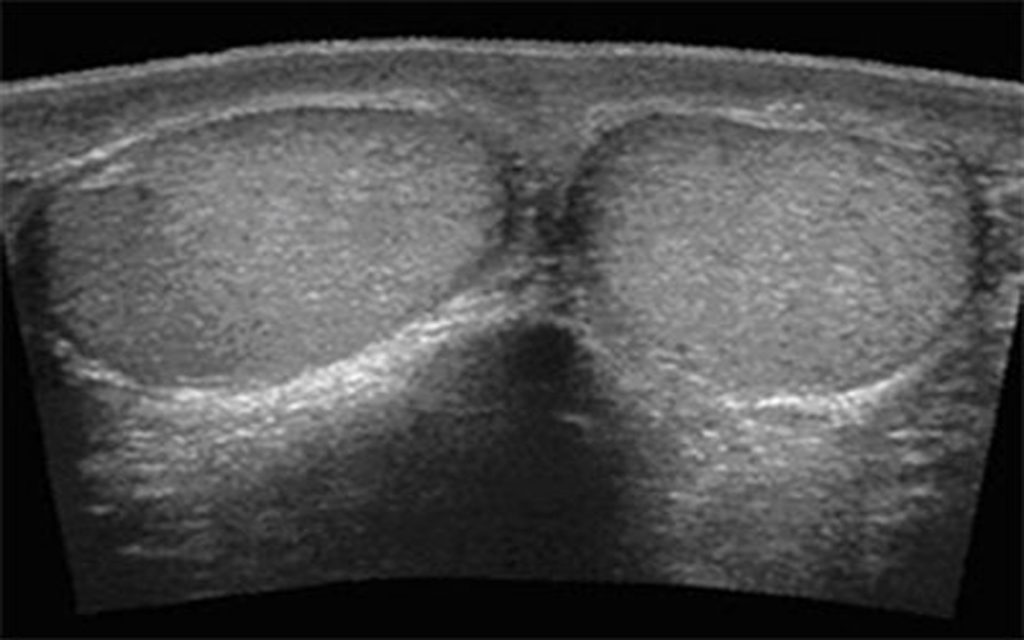 سونوگرافی بیضه
