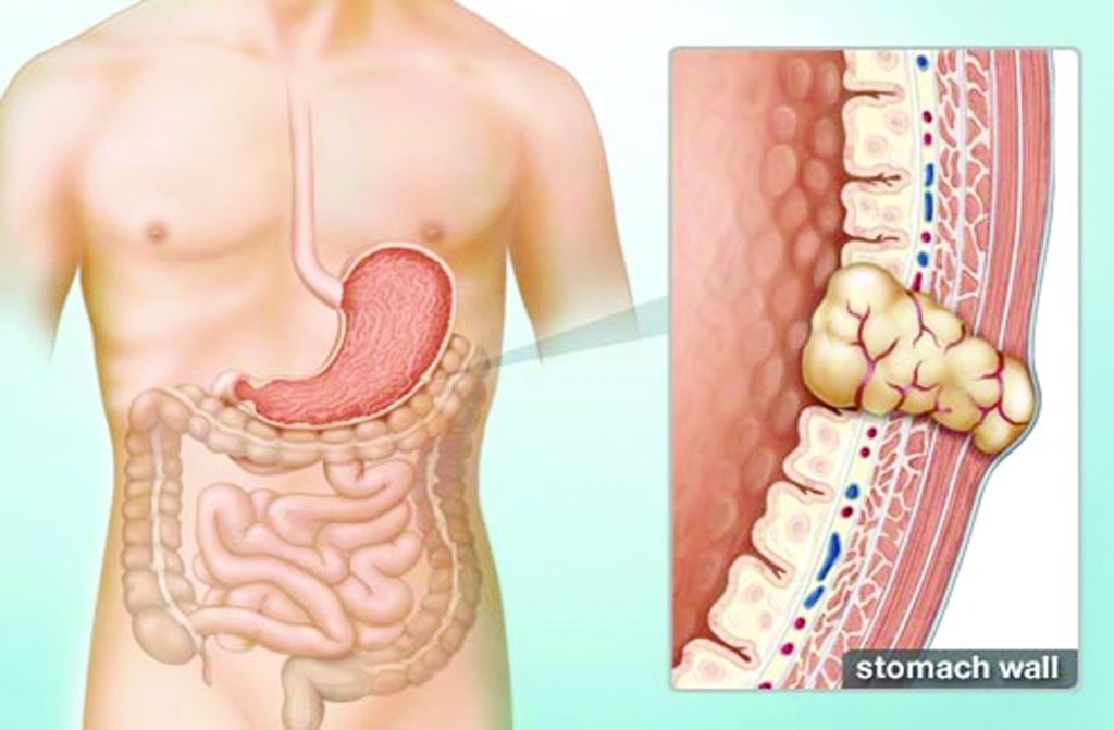 تومور استرومال دستگاه گوارش