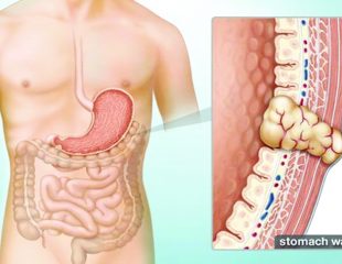 تومور استرومال دستگاه گوارش