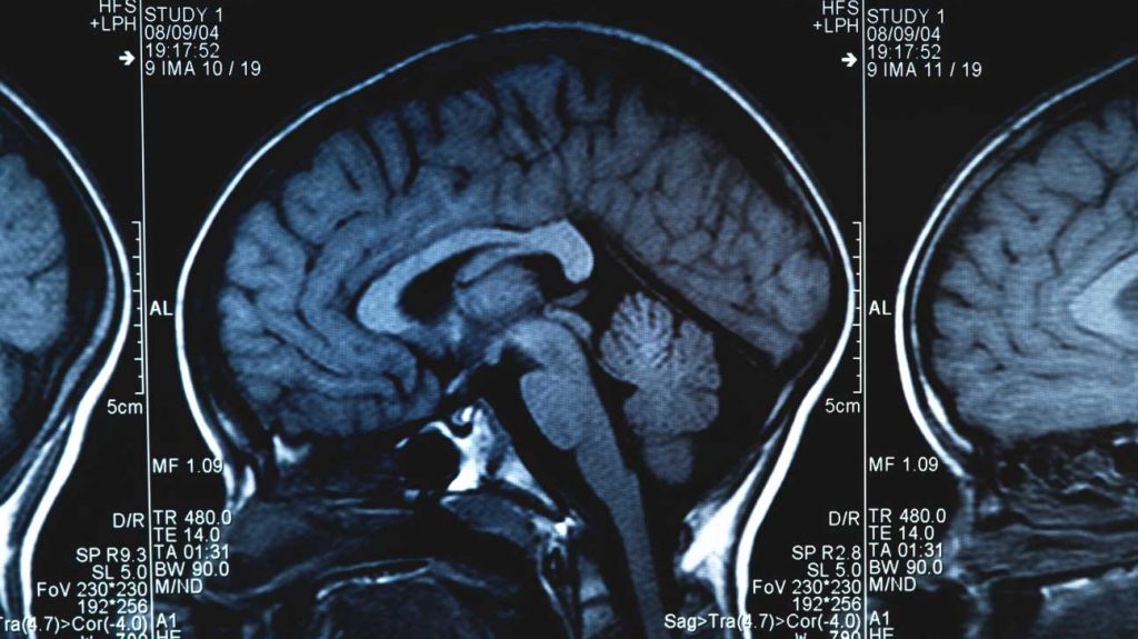 تشخیص تومورهای مغز و نخاع در بزرگسالان