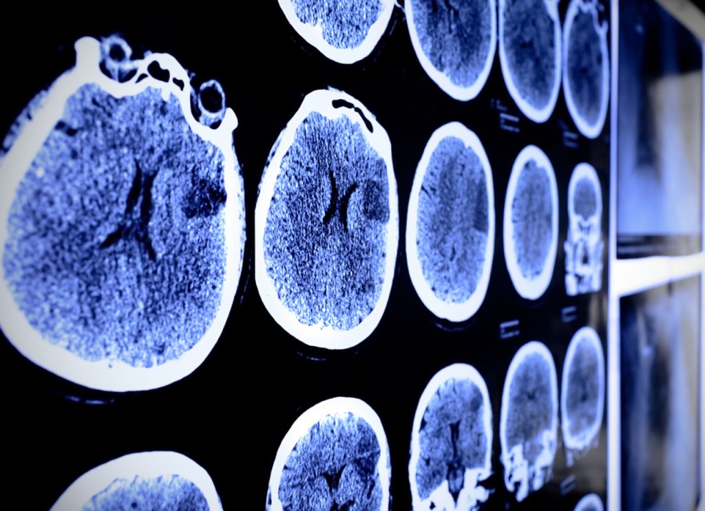 عوامل خطرساز تومورهای مغز و نخاع چیست؟