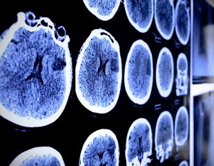 عوامل خطرساز تومورهای مغز و نخاع چیست؟