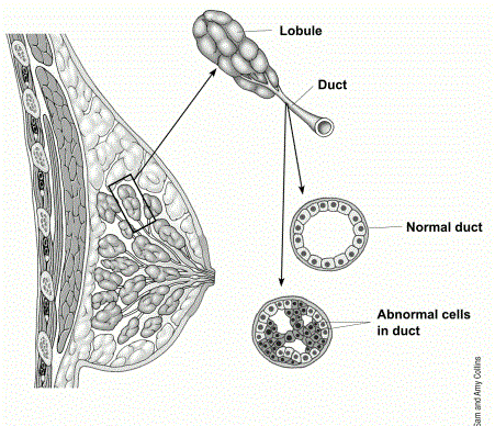 کارسینوم مجرایی درجا