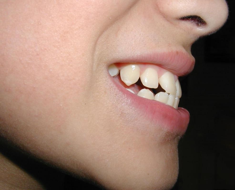 ناهنجاری دندان ها