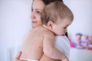 پنومونی واریسلایی پنومونی واریسلایی