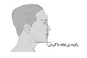 زاویه ی ایده آل چانه با گردن