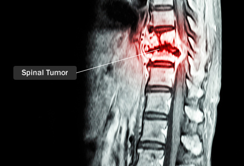 تومور ستون فقرات