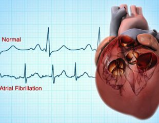 علایم, تشخیص, درمان و پیشگیری از فیبریلاسیون دهلیزی