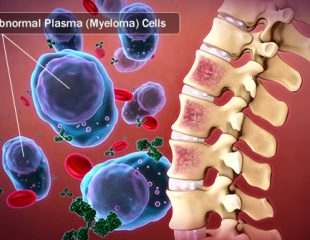راهنمای تصویری مولتیپل میلوما یا سرطان سلول های پلاسما