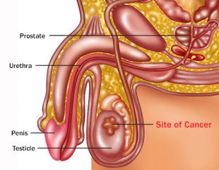 راهنمای تصویری سرطان بیضه