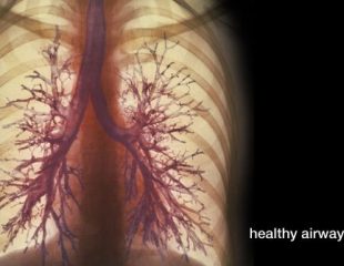 راهنمای بصری برای بیماری انسداد مزمن مجاری تنفسی