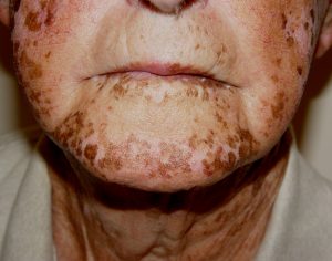شناخت بیماری آدیسون شناخت بیماری آدیسون